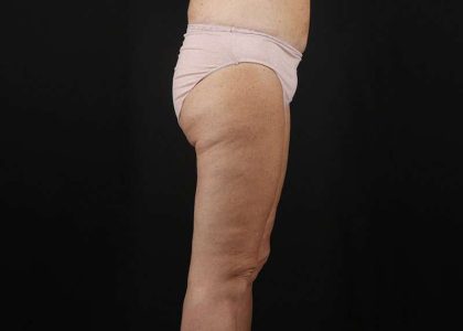 Thigh Lift Before & After Patient #1818