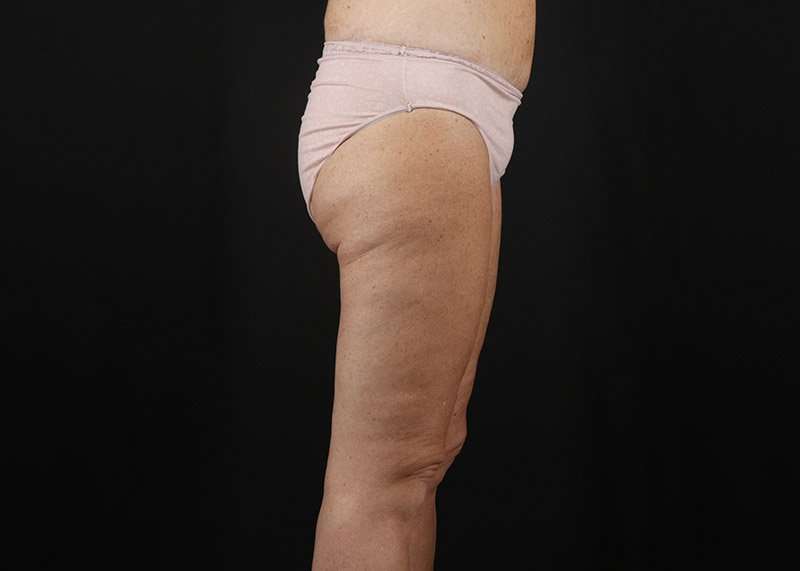 Thigh Lift Before & After Patient #1818