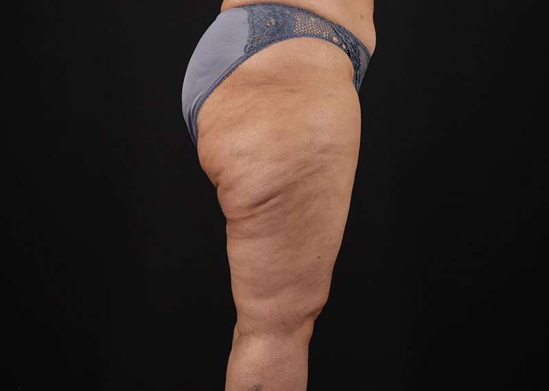 Thigh Lift Before & After Patient #1831