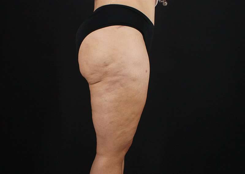 Thigh Lift Before & After Patient #1844