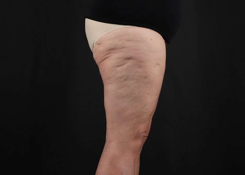 Thigh Lift Before & After Patient #1857