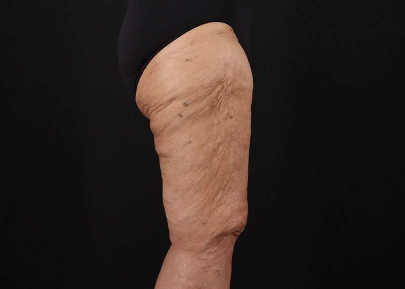 Thigh Lift Before & After Patient #1871