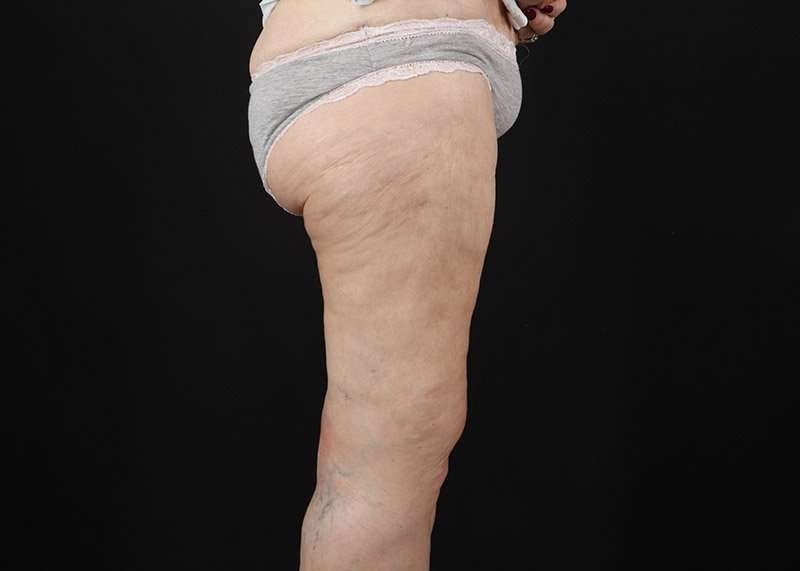 Thigh Lift Before & After Patient #1884
