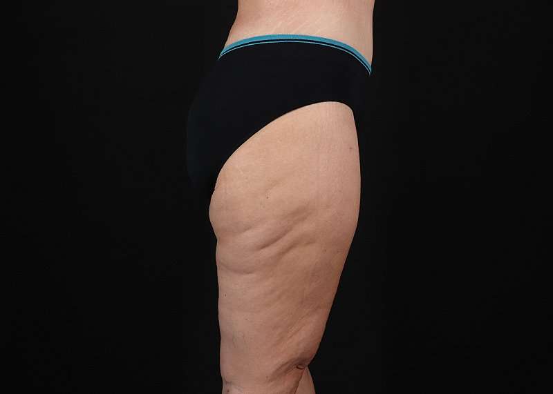 Thigh Lift Before & After Patient #1897