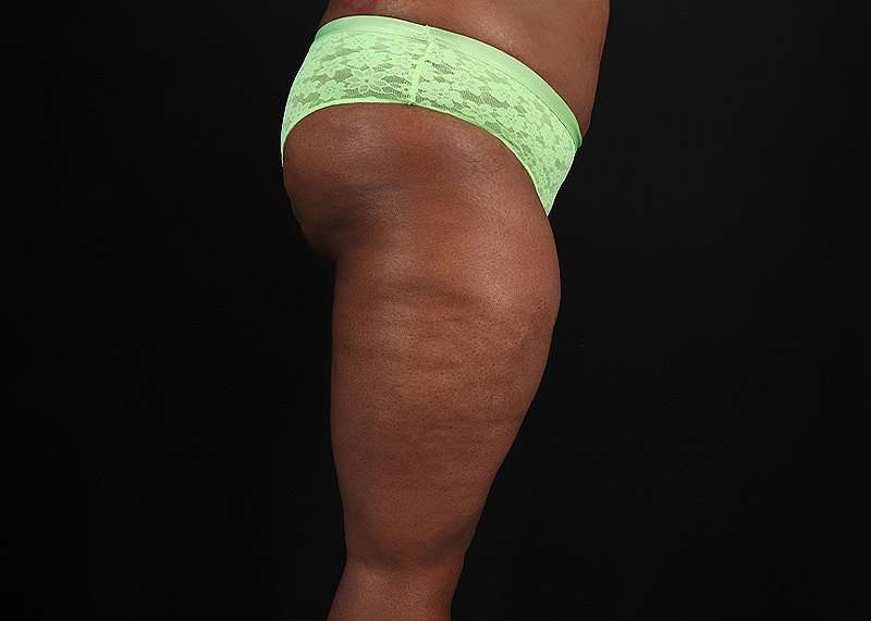Thigh Lift Before & After Patient #1911
