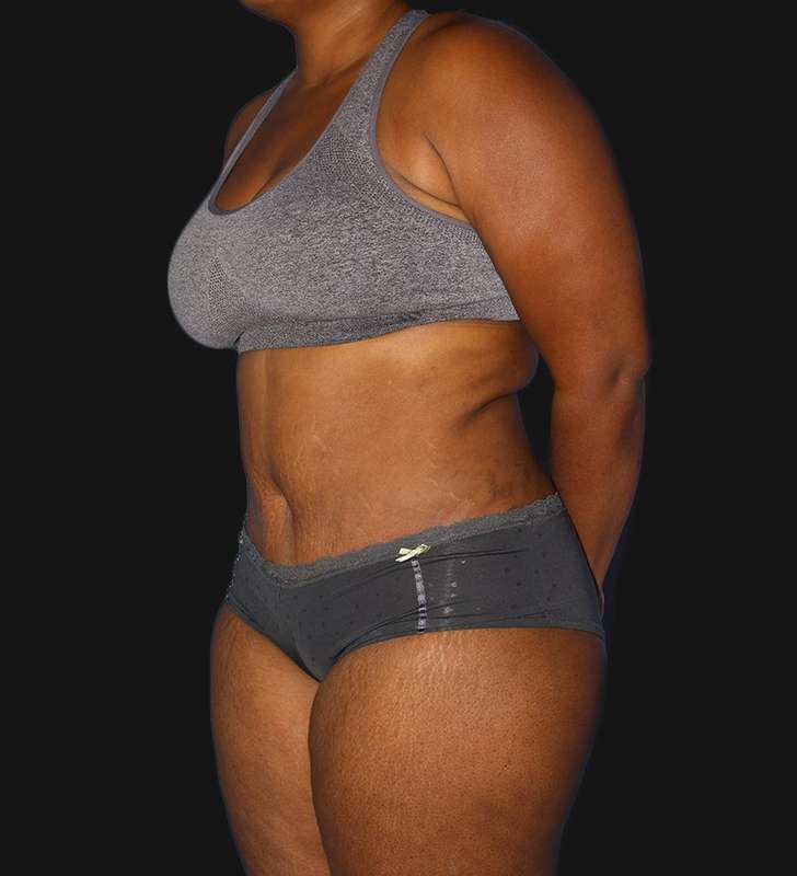 Abdominoplasty (Tummy Tuck) Before & After Patient #568