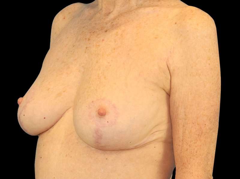 Breast Reduction Before & After Patient #2474