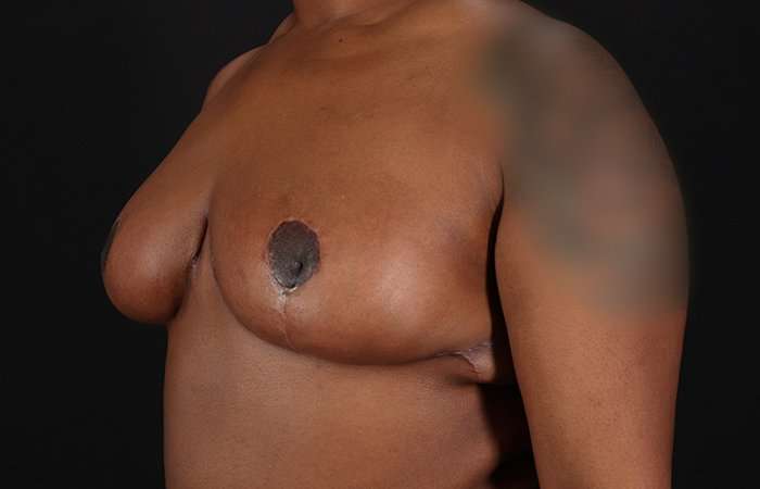 Breast Reduction Before & After Patient #2487