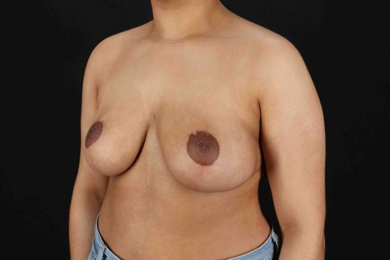 Breast Reduction Before & After Patient #2498