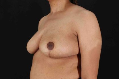 Breast Reduction Before & After Patient #2509