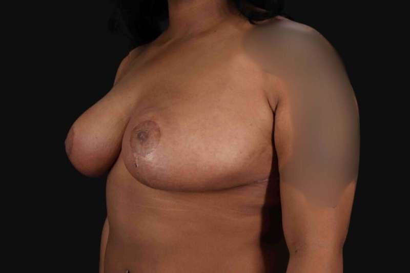 Breast Reduction Before & After Patient #2602