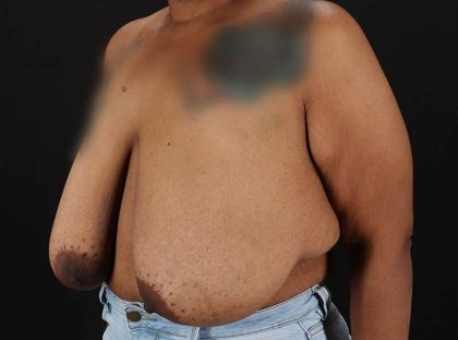 Breast Reduction Before & After Patient #2646