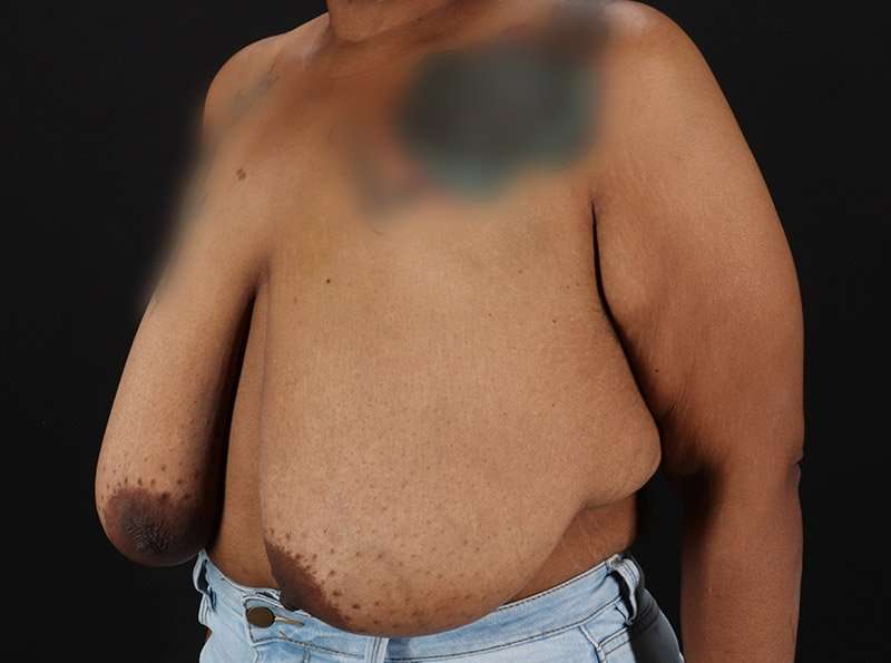 Breast Reduction Before & After Patient #2646