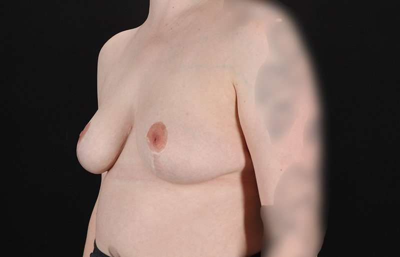 Breast Reduction Before & After Patient #2687