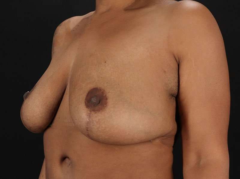 Breast Reduction Before & After Patient #2777