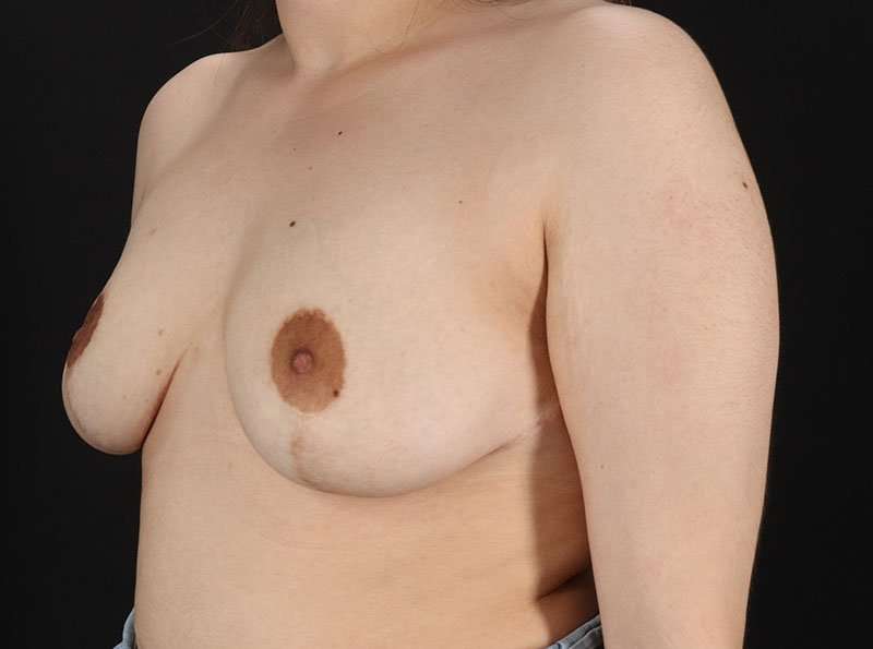 Breast Reduction Before & After Patient #2788