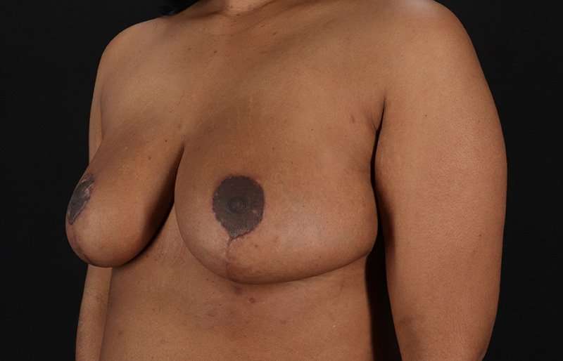 Breast Reduction Before & After Patient #2824