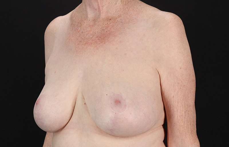Breast Reduction Before & After Patient #2836