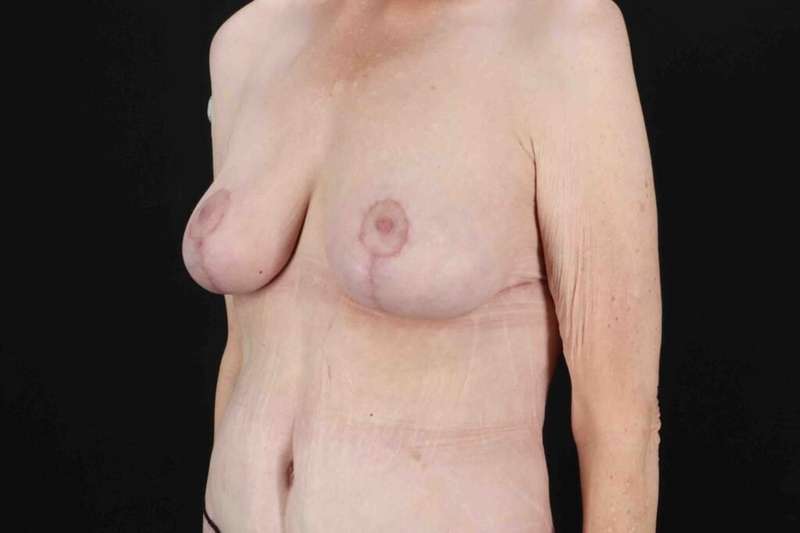 Breast Reduction Before & After Patient #2847