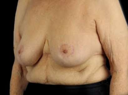 Breast Reduction Before & After Patient #2859