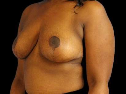 Breast Reduction Before & After Patient #2870