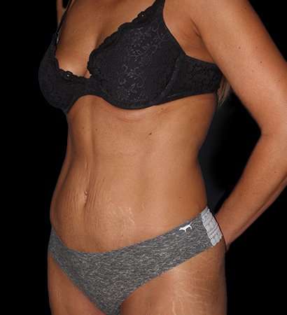 Abdominoplasty (Tummy Tuck) Before & After Patient #757