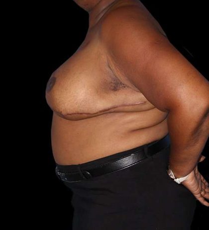 DIEP Flap Before & After Patient #2930