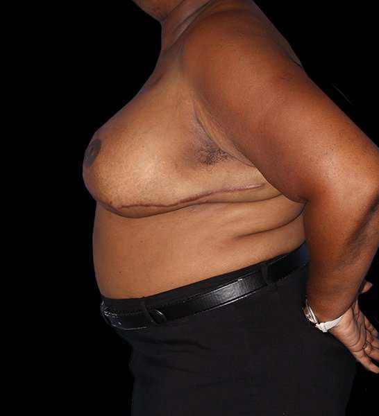DIEP Flap Before & After Patient #2930