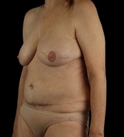 DIEP Flap Before & After Patient #2943