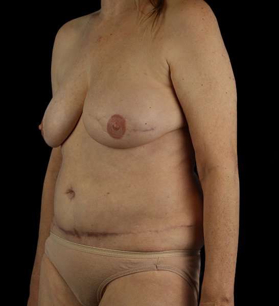 DIEP Flap Before & After Patient #2943