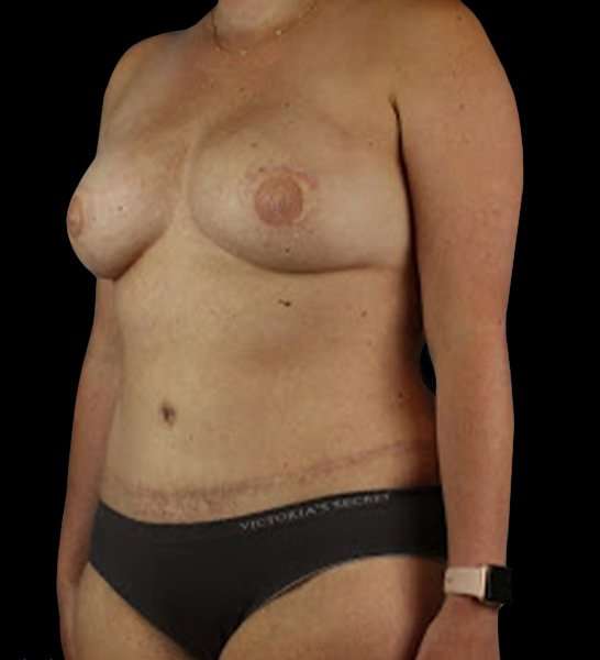 DIEP Flap Before & After Patient #2954