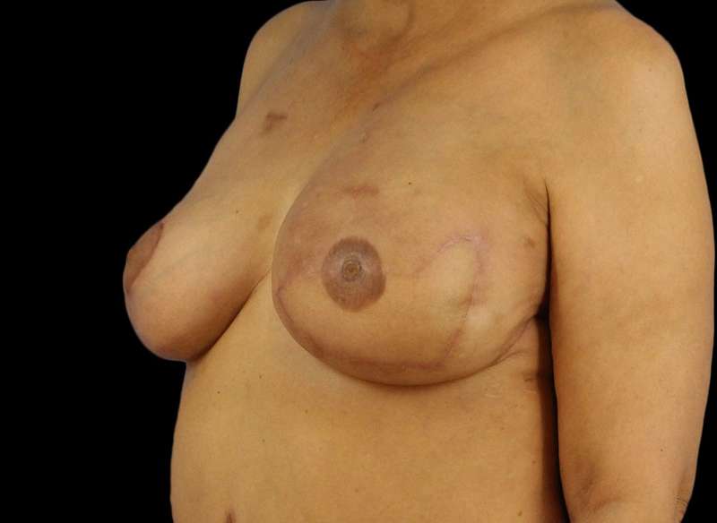 DIEP Flap Before & After Patient #3030