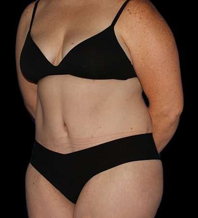 Abdominoplasty (Tummy Tuck) Before & After Patient #768
