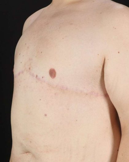 Gynecomastia Before & After Patient #3162
