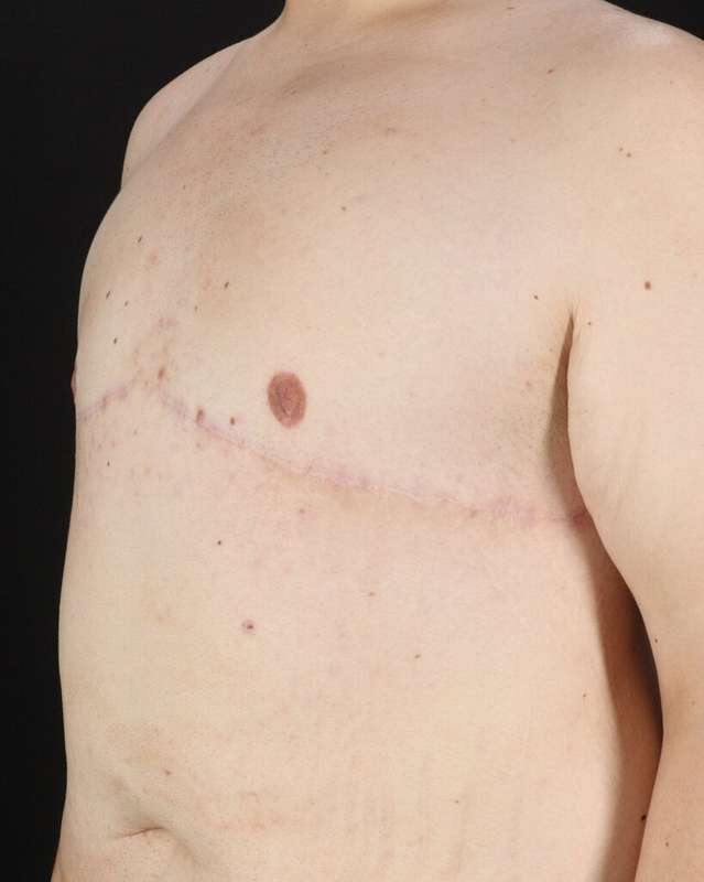 Gynecomastia Before & After Patient #3162