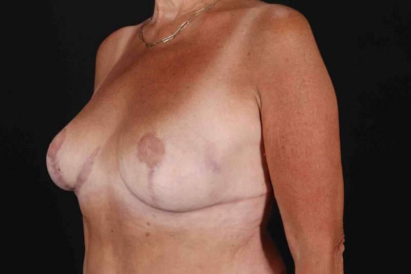 Breast Reduction With Lift Before & After Patient #3312