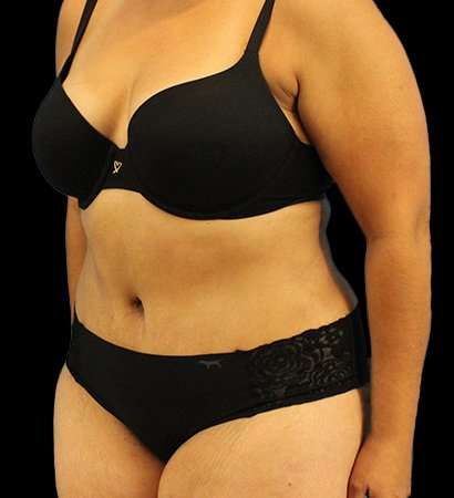 Abdominoplasty (Tummy Tuck) Before & After Patient #779
