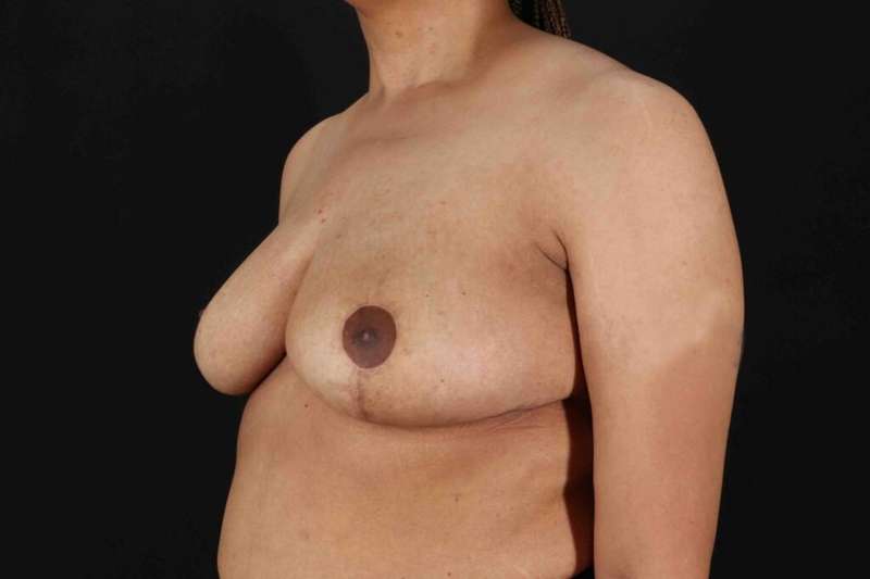 Breast Reduction With Lift Before & After Patient #3323