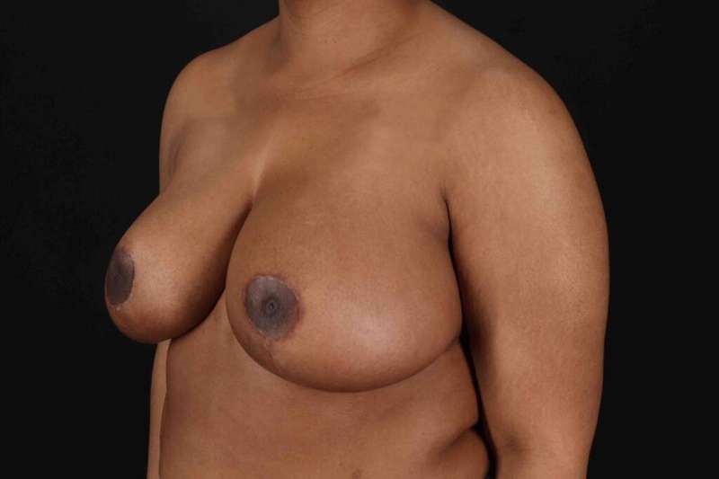 Breast Reduction With Lift Before & After Patient #3400