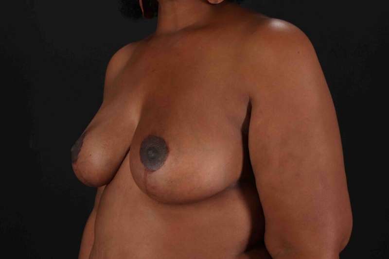 Breast Reduction With Lift Before & After Patient #3411