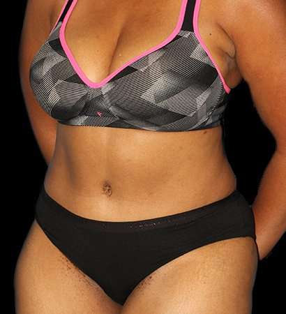 Abdominoplasty (Tummy Tuck) Before & After Patient #790