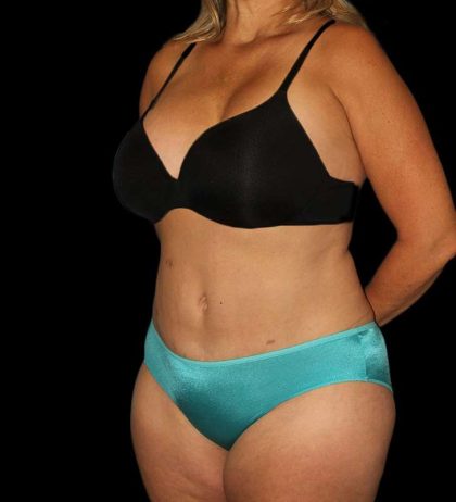 Abdominoplasty (Tummy Tuck) Before & After Patient #579