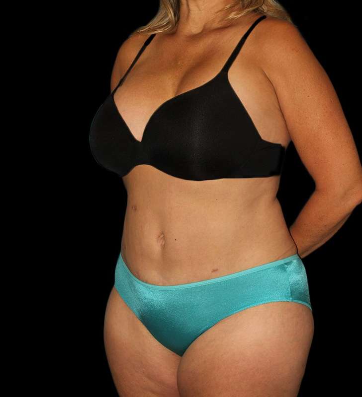 Abdominoplasty (Tummy Tuck) Before & After Patient #579