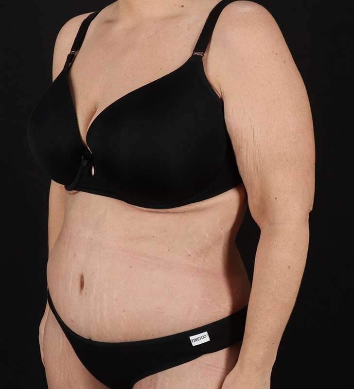 Abdominoplasty (Tummy Tuck) Before & After Patient #817
