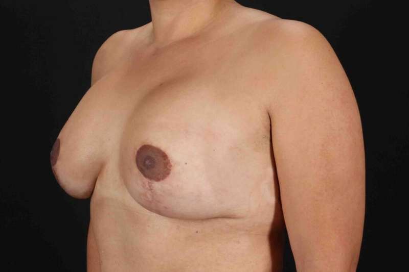 Breast Lift Before & After Patient #3717