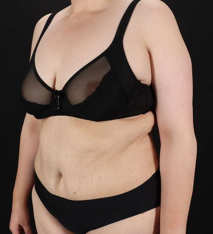 Abdominoplasty (Tummy Tuck) Before & After Patient #830