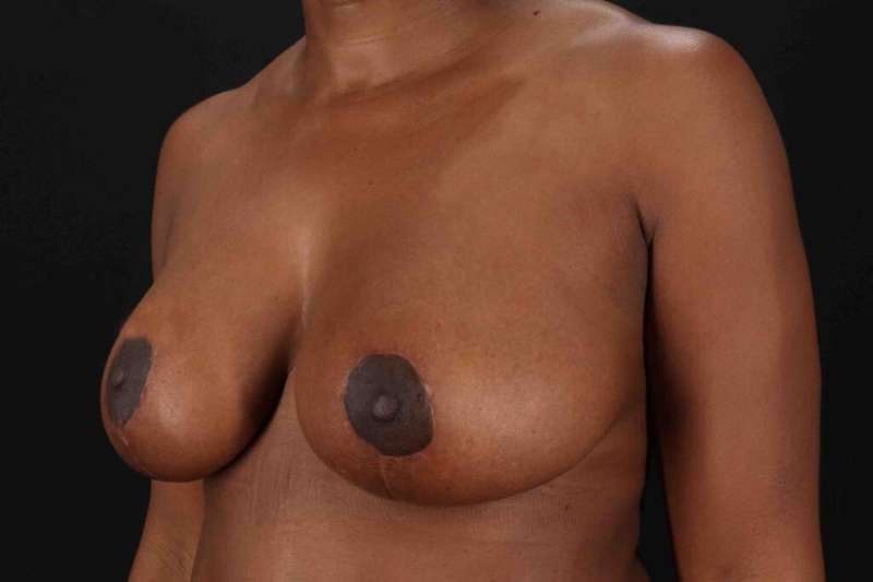 Breast Lift Before & After Patient #3875