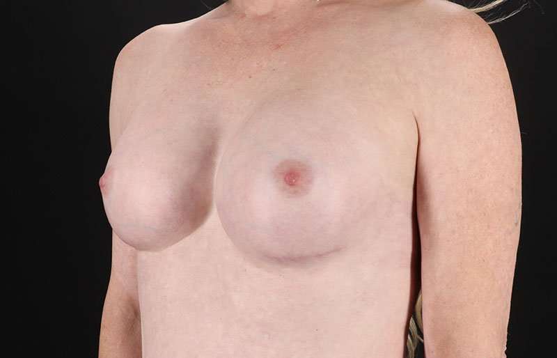 Male To Female Breast Before & After Patient #3911