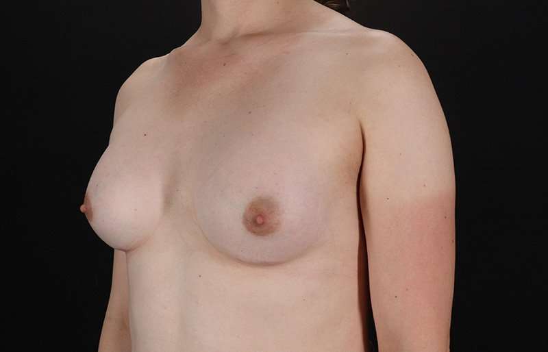 Male To Female Breast Before & After Patient #3933