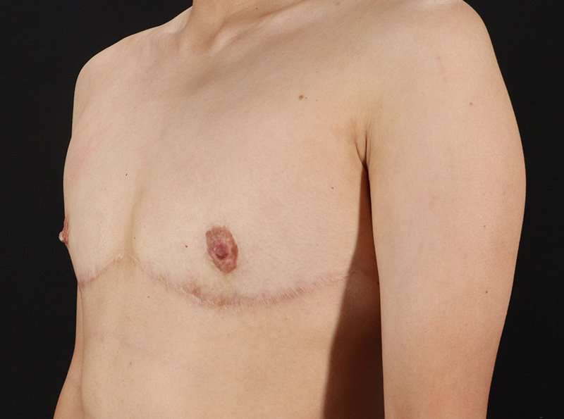 Female To Male Breast Before & After Patient #3944